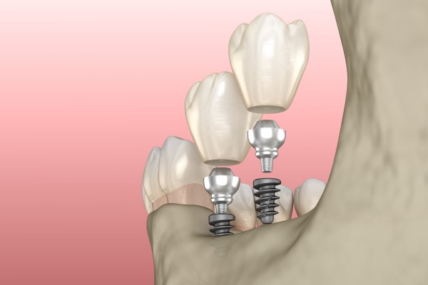 Dental Implants Pembroke Pines, FL