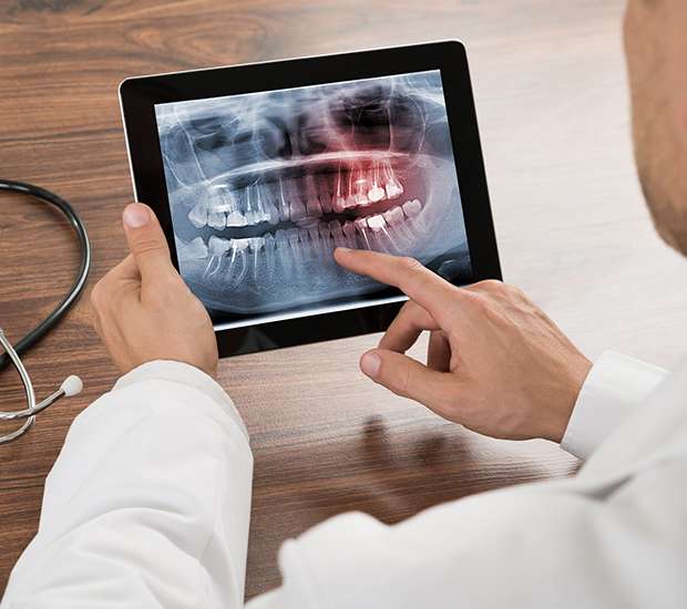 Pembroke Pines Types of Dental Root Fractures